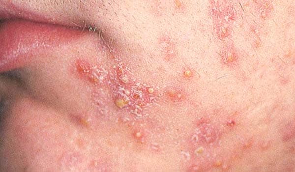 Common Skin Disorders - Healthline