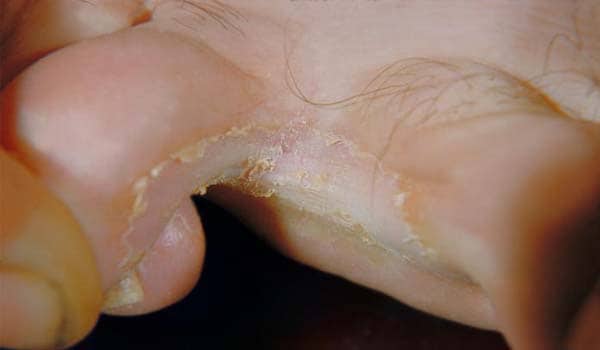 skin problems on feet #11