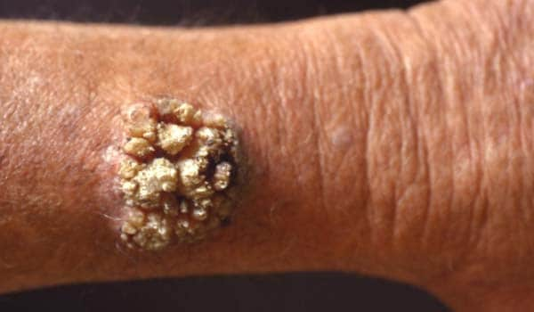 common wart. Common skin problems. Warts: