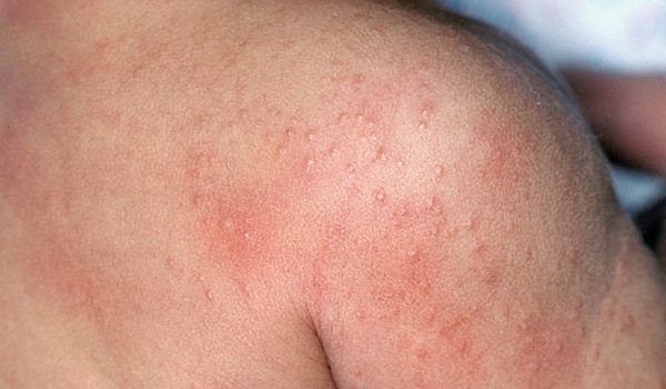 viral infectious rashes #10