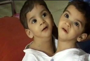 बैतूल : सीने से जुड़ी दो बच्चियों का होगा ऑपरेशन, एनडीटीवी ने की मदद