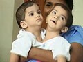 Video : Betul's conjoined twins to be separated, thanks to NDTV viewers' help