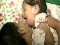 Video : Madhya Pradesh's Siamese twins to be separated tomorrow