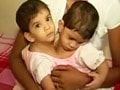 Video : Betul's conjoined twins successfully separated after 12-hour surgery