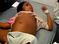 Video : Over 6000 Kala Azar cases reported in Bihar