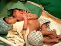 Video : NDTV viewers help conjoined twins