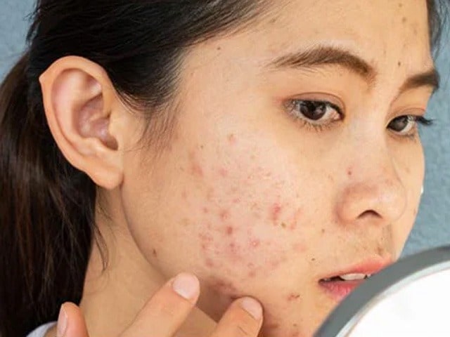 Photo : These 5 Diet Tips May Help Reduce Acne