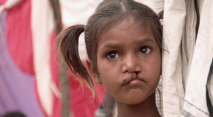 <I>Smile Pinki</I> focused on a girl whose cleft lip made her a social outcast till her life changed after a meeting with a social worker.