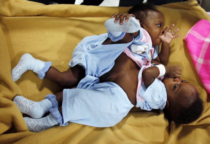 Eight-month old Nigerian conjoined twins named Peace, below, and Patience look on as they lie on a bed during a press meet at Narayana Hrudayalaya hospital in Bangalore, India, Saturday, May 29, 2010. Peace and Patience, who weigh 10 kilograms are scheduled to be operated next week by a team of 24 medical personnel. The twins are joined at the abdomen, sharing liver and intestine and are called omphalopagus, the hospital statement said. (Photo: AP)