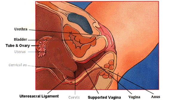 Tear in the cervix, which may be repaired with stitches, which occurs in less than 1% of cases.