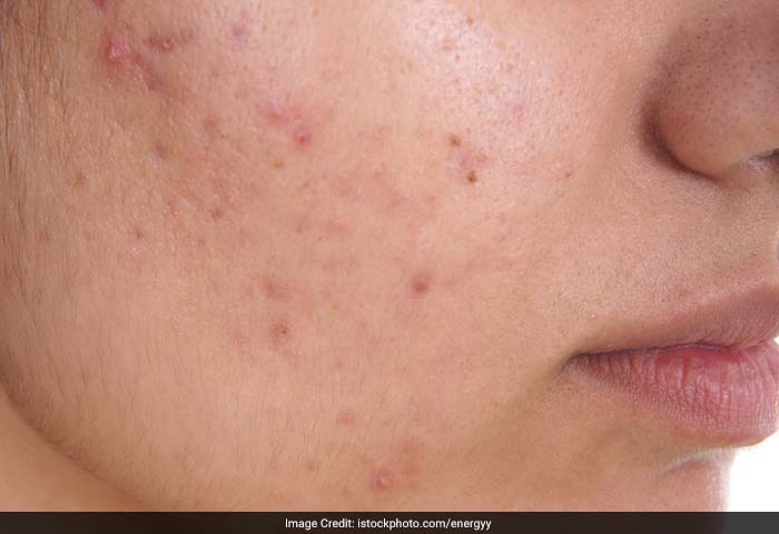 Acne: Acne is due to over activity and plugging of the oil glands. The main underlying cause of acne is increased levels of hormones during adolescence.