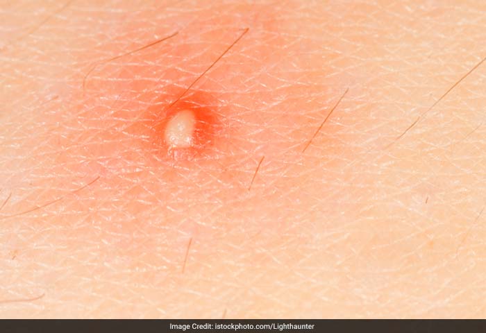 Boils: Boils are painful, pus-filled bumps that form under the skin. It usually appears suddenly as a painful pink or red bump about 1/2 inch in diameter.