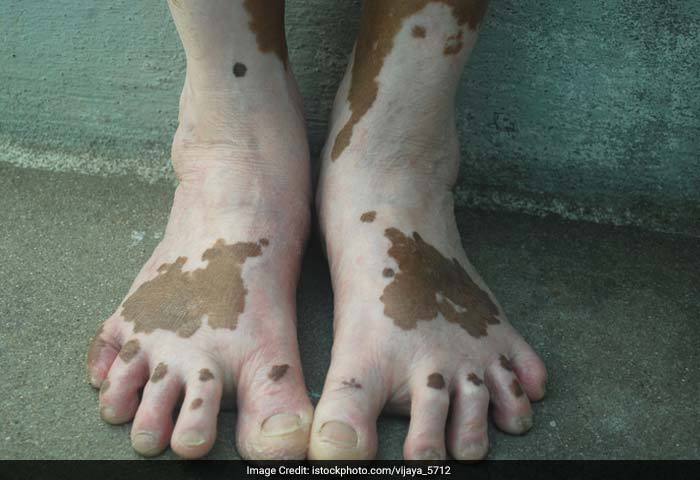 Vitiligo: Vitiligo, also known as leucoderma, is a relatively common skin disorder, in which white spots or patches appear on the skin caused by the destruction or weakening of the pigment cells.