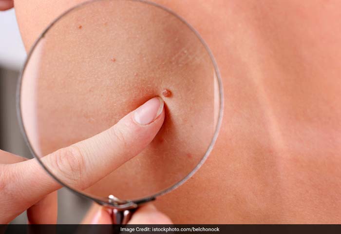 Moles: Moles are usually harmless collections of pigmented cells called melanocytes on the skin. These can also be present in more obscure locations such as the scalp, under the nails, in the armpits and around the genitals.
