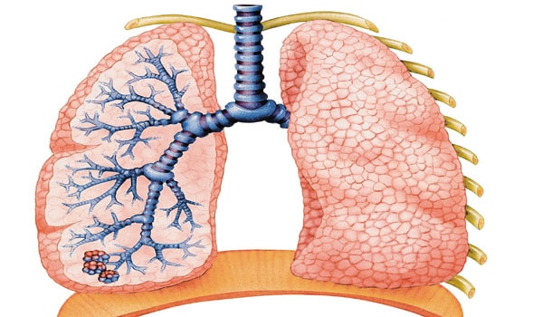 Sulphur dioxide (SO2) in the air is caused due to the rise in combustion of fossil fuels. It can oxidize and form sulphuric acid mist. SO2 in the air leads to diseases of the lung and other lung disorders such as wheezing and shortness of breath.