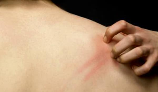 Body rashes that may or may not be itchy, usually red and spotty, on the upper body, face and neck may also occur.