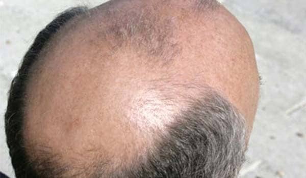 Androgenic alopecia also known as male pattern baldness is the most common type of hair loss. It occurs more frequently in men than in women. It is a permanent type of hair loss and occurs in a characteristic pattern on the scalp. The hair loss begins at the temples and at the top of the head towards the back, causing a receding hairline and a bald spot. Balding may begin at any age after puberty and can range from partial loss to complete baldness. Hormonal imbalance, mainly testosterone, and genetic factors are responsible for this type of hair loss.
