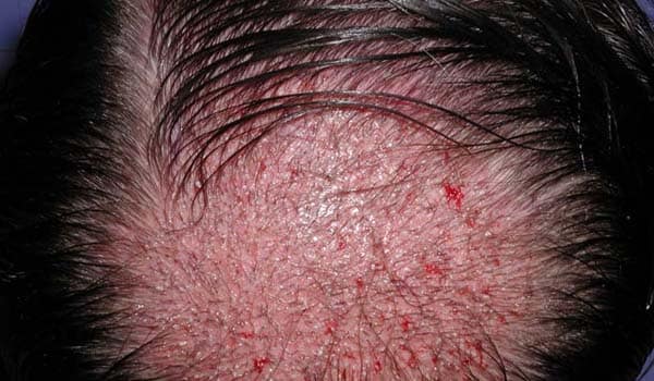 Hair transplantation: This involves the transplantation of hair follicles from areas of the scalp where hair is still growing to areas where it is not. This carries a low risk for skin infections and may cause minor scarring in the donor areas.
