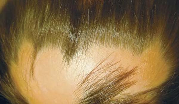 Alopecia areata leads to patchy hair loss on the scalp. The exact cause is not known, but it is thought to be the result of the bodys immune system attacking the hair follicles.