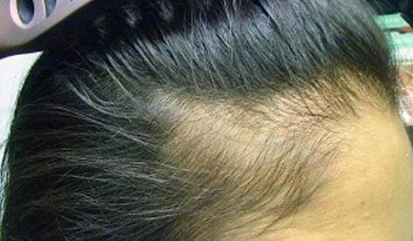 Traction alopecia is caused due to long-term pulling on the hair. This is caused by certain hairstyles, such as tight braids. The hair loss is usually reversible once the cause of the pulling is eliminated.