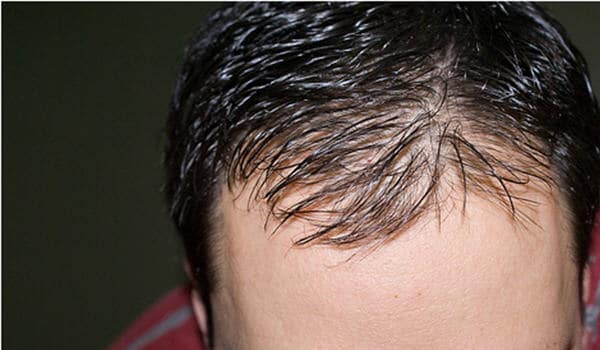 Baldness or alopecia results when hair loss occurs at an abnormally high rate, replacement occurs at an abnormally slow rate or when normal hairs are replaced by thinner, shorter ones.