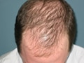 Photo : Baldness: Causes and treatment
