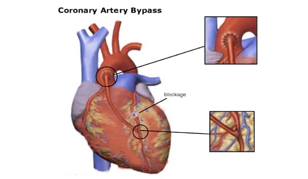 CABG or bypass surgery - Picture 2 » DoctorNDTV.com