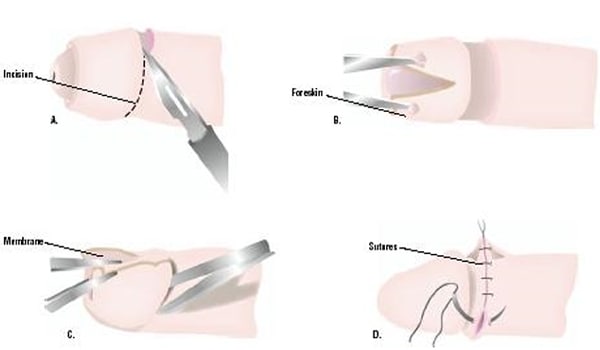 Circumcision is a preventive measure but is by no means a guarantee that medical issues will not develop later in life at the tip of the penis.