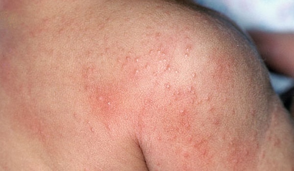 Rash, which shows up 3-4 days after the start of the symptoms, starting from the trunk region and spreading to the face, arms and legs.
