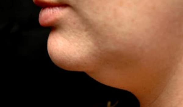 Double chins tend to come with age but they are not inevitable and one can get rid of them without surgery. There are several reasons behind them - genetic tendency; lack of exercise and fat and fluid build-up.