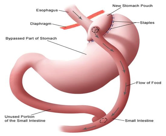 Gastric bypass can be done in two ways : in open surgery, the surgeon will make a large incision to open up the belly. The surgeon will do the bypass by directly handling your stomach, small intestine, and other organs. Another way to this surgery is to use a tiny camera, called a laparoscope, which is placed in your belly.