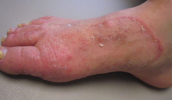 Medical Term For Fungal Infections Of The Feet Is