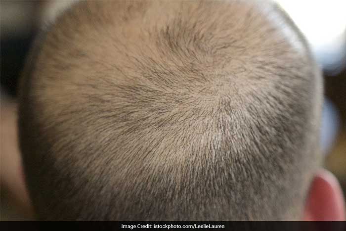 Medical treatments. Undergoing chemotherapy or radiation therapy may cause you to develop alopecia. After your treatment ends, your hair typically begins to regrow.