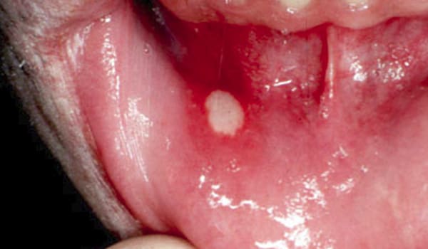 Look inside your mouth regularly for sores that dont heal, irritated gums or other changes.