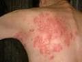 Photo : Preventing herpes infection