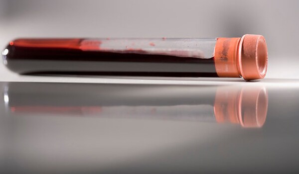 If you notice some signs and symptoms of herpes (like fever, blisters and cold sores), get yourself tested of herpes.