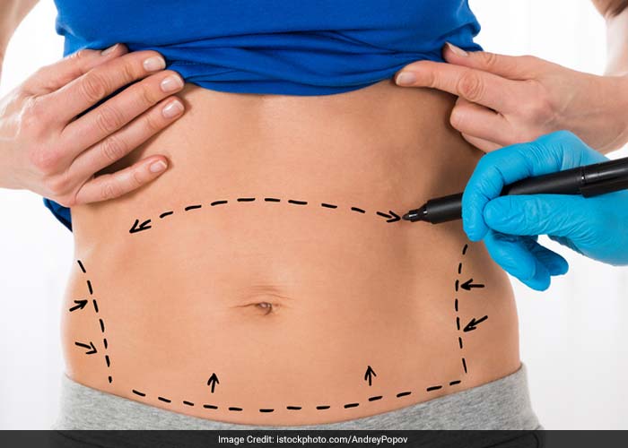 Many alternatives to liposuction may be considered, including abdominoplasty (tummy tuck), excision of lipomas (fatty tumour), reduction mammoplasty (breast size reduction), or a combination of plastic surgery approaches.