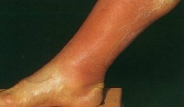 Thrombophlebitis leads to redness along the affected segment of the vein.