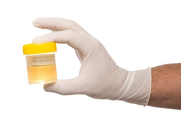 Routine urine test is done to test for sugar, for any blood and protein that might suggest a bladder or kidney problem, for hepatitis, infections etc.