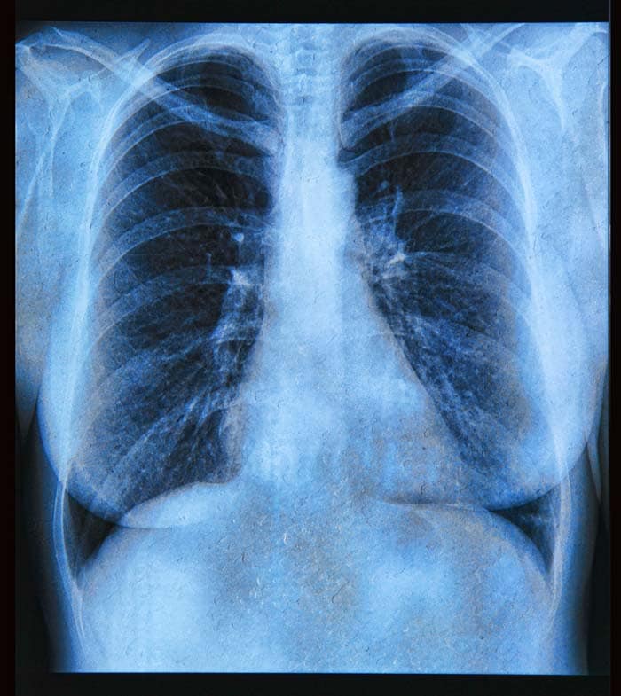 X-rays can be done to detect lung abnormalities (tuberculosis, emphysema or lung cancer) early enough to initiate a proper treatment.