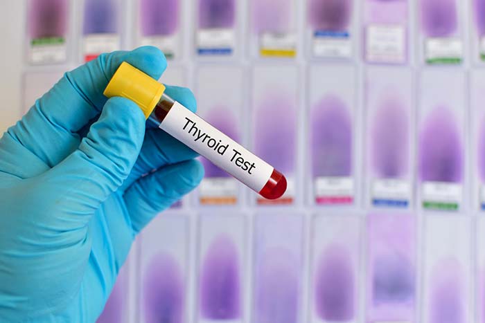 Thyroid function test should be done to rule out any thyroid disorder, which includes estimation of the blood levels of thyroid hormones, T4 and the T3.