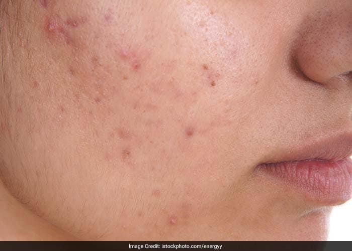 The most efficient way to avoid acne scarring is by preventing acne from worsening. Dont take acne lightly. Start the treatment as soon as it develops. If you are unable to treat it with over-the-counter medicines, consult a dermatologist.
