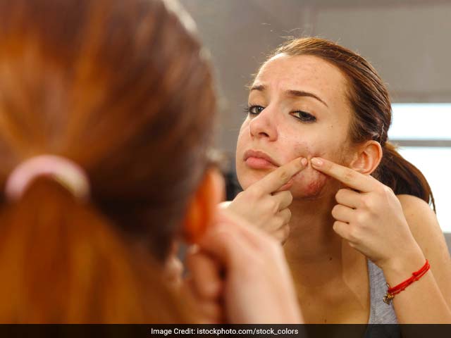 Photo : Preventing acne scars