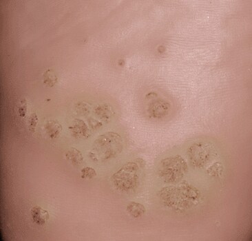 Genital warts are caused by the Human papilloma virus (HPV) which causes small growths on the skin and mucous membranes. They grow best in moist genital areas and are flesh-coloured tumours appearing singly or in clusters. In women, HPV can invade the vagina and cervix and may lead to cancerous changes in the cervix.