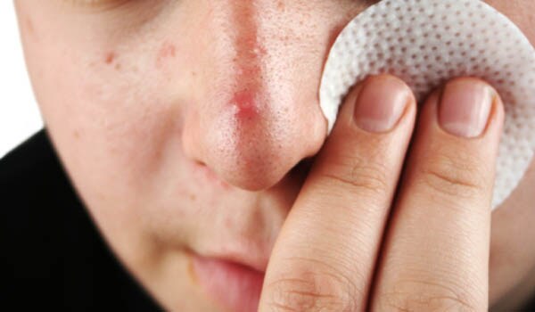 The most common problem that a teenager faces is acne. This is because of fluctuating hormone levels and inherited genes.