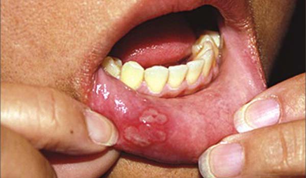 Mouth sores – Various types of sores can appear anywhere within the mouth, including the inner cheeks, gums, tongue, lips, or palate. Mouth sores generally last for 10 to 14 days and even last up to 6 weeks. The following tips may make you feel better:<br>
-Gargle with cool water. This is particularly helpful if you have a mouth burn.<br>
-Avoid hot beverages and foods, spicy and salty foods and citrus.<br>
-Take pain relievers like acetaminophen.
