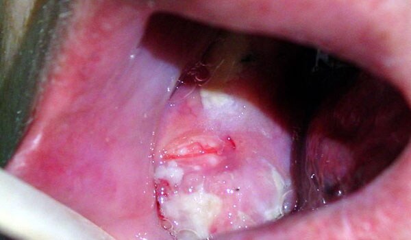Oral cancer - Oral cancer is a cancerous tissue growth located in the oral cavity. Oral cancers may originate in any of the tissues of the mouth.  It may also occur on the floor of the mouth, cheek lining, gums or roof of the mouth. Smoking and other tobacco use are associated with about 75 percent of oral cancer cases, caused by irritation of the mucous membranes of the mouth from smoke and heat of cigarettes, cigars, and pipes.  Alcohol drinking is   another high-risk activity associated with oral cancer.