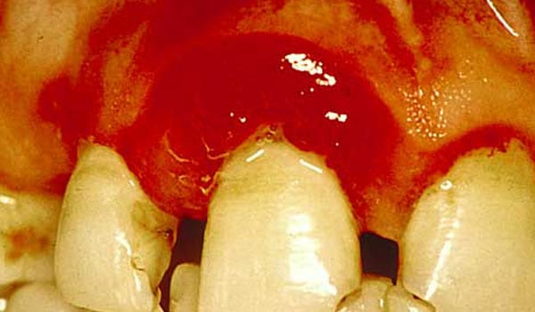 Bleeding gums - Bleeding from the gums is mainly due to inadequate plaque removal from the teeth at the gum line. This will lead to a condition called gingivitis, or inflamed gums. Gingivitis is the inflammation of the gums around the teeth due to improper cleaning of the teeth. The usual signs of gingivitis are gums, which are swollen and bleed during brushing.