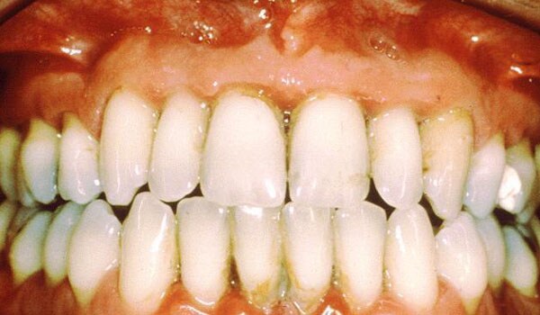 Gum disease - Gum disease (also called periodontal disease), is an infection of the tissues that support the teeth.  Gum disease is caused by plaque, which is a sticky film of bacteria, mucous and food debris that constantly forms on the teeth. Regular and proper brushing along with good dental hygiene are important for preventing gum disease.