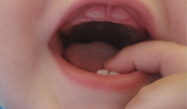 A vigorous thumb-sucker can harm her teeth – the upper teeth will protrude forward while the lower tend to be drawn inwards or backwards. Since this habit is mainly in children under five years of age and the harm is done primarily to the milk teeth, one need not worry too much about it. However if this habit persists beyond the age of five, the permanent teeth will also be affected, leading to expensive dental treatment for malformed teeth.